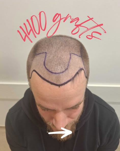 Hair Replacement Surgery UK - Trusted Clinic in London, Leeds &amp; Manchester