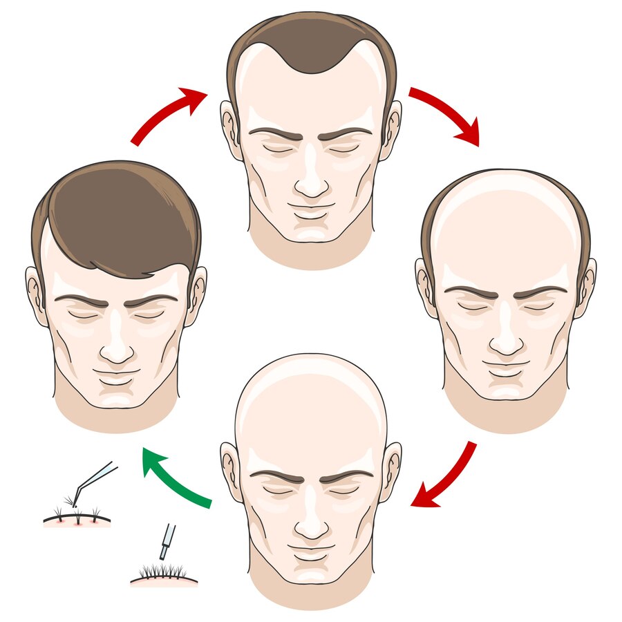 Stop Hair Loss Today - Book the Best FUE Hair Transplant in the UK!