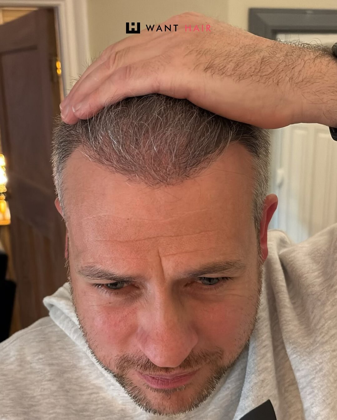 Get Your Confidence Back - Book Your Hair Transplant Consultation Today!